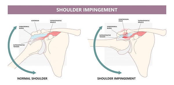 Impingement syndrom_3